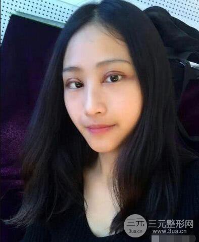 常州二院整形科李新庆割双眼皮前后对比图 单眼皮变身双眼皮大眼睛