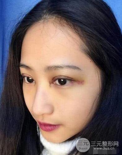 常州二院整形科李新庆割双眼皮前后对比图 单眼皮变身双眼皮大眼睛