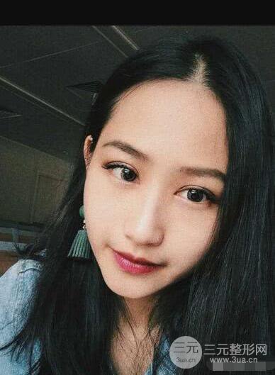 常州二院整形科李新庆割双眼皮前后对比图 单眼皮变身双眼皮大眼睛