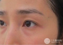 超声波去眼袋降低风险吗？恢复图片果真实分享~