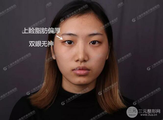 上海华美杨亚益全切双眼皮案例对比图 男女双眼皮案例混搭