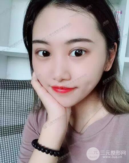 上海华美杨亚益全切双眼皮案例对比图 男女双眼皮案例混搭