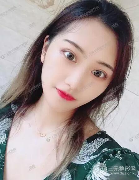 上海华美杨亚益全切双眼皮案例对比图 男女双眼皮案例混搭