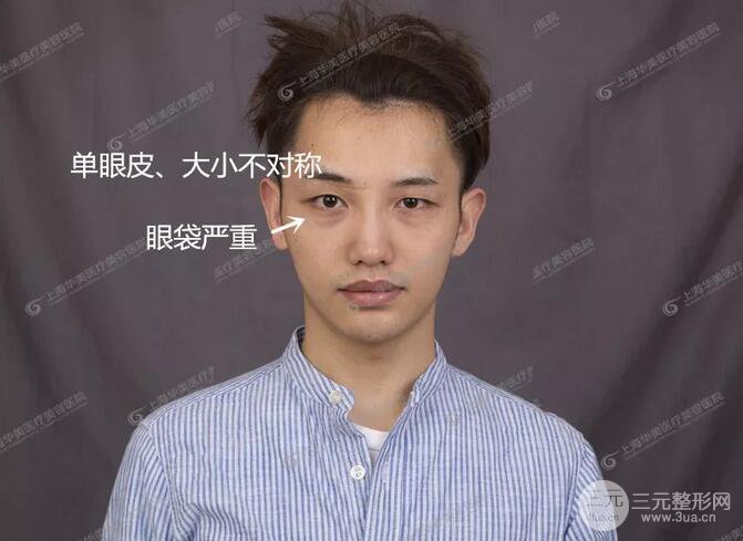 上海华美杨亚益全切双眼皮案例对比图 男女双眼皮案例混搭