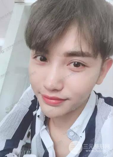 上海华美杨亚益全切双眼皮案例对比图 男女双眼皮案例混搭