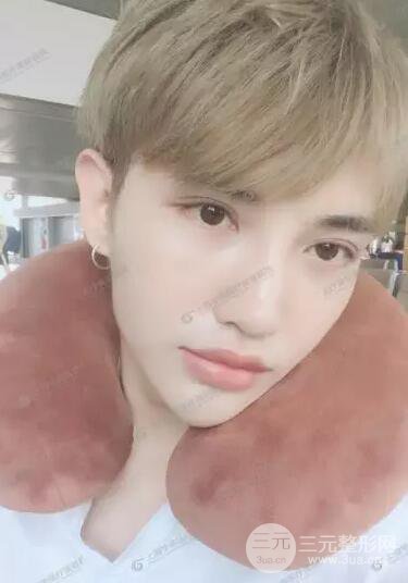 上海华美杨亚益全切双眼皮案例对比图 男女双眼皮案例混搭