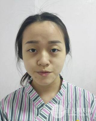 保定蓝山卢闯全切双眼皮真实案例前后对比图心情小札分享