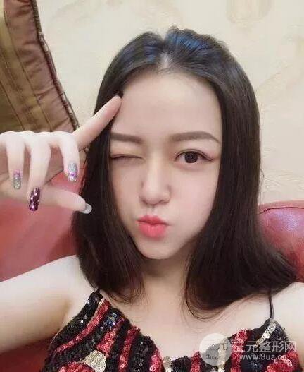 保定蓝山卢闯全切双眼皮真实案例前后对比图心情小札分享