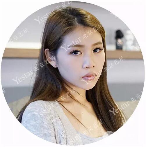 北京艺星仇侃敏耳软骨隆鼻恢复过程|内附前后对比图