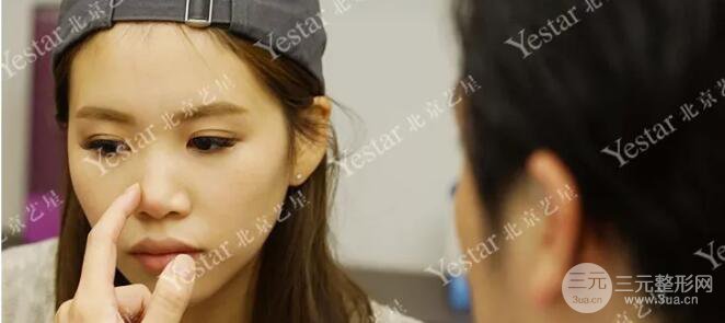 北京艺星仇侃敏耳软骨隆鼻恢复过程|内附前后对比图