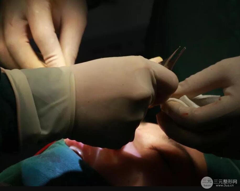 北京艺星仇侃敏耳软骨隆鼻恢复过程|内附前后对比图