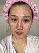 果酸换肤能祛痘坑吗？缓解20天的果真的是太明X了！