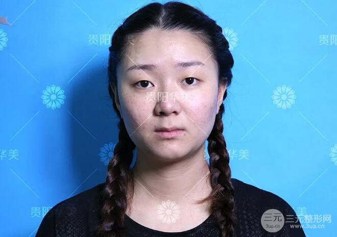 贵阳华美郭宗科全切双眼皮+假体隆鼻案例前后对比图 华美员工全脸整形实录