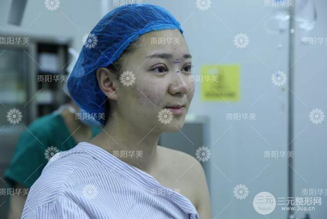 贵阳华美郭宗科全切双眼皮+假体隆鼻案例前后对比图 华美员工全脸整形实录