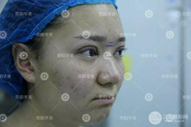 贵阳华美郭宗科全切双眼皮+假体隆鼻案例前后对比图 华美员工全脸整形实录