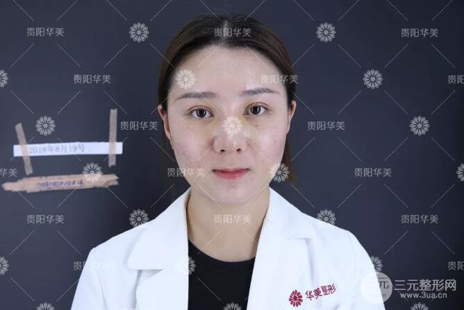 贵阳华美郭宗科全切双眼皮+假体隆鼻案例前后对比图 华美员工全脸整形实录