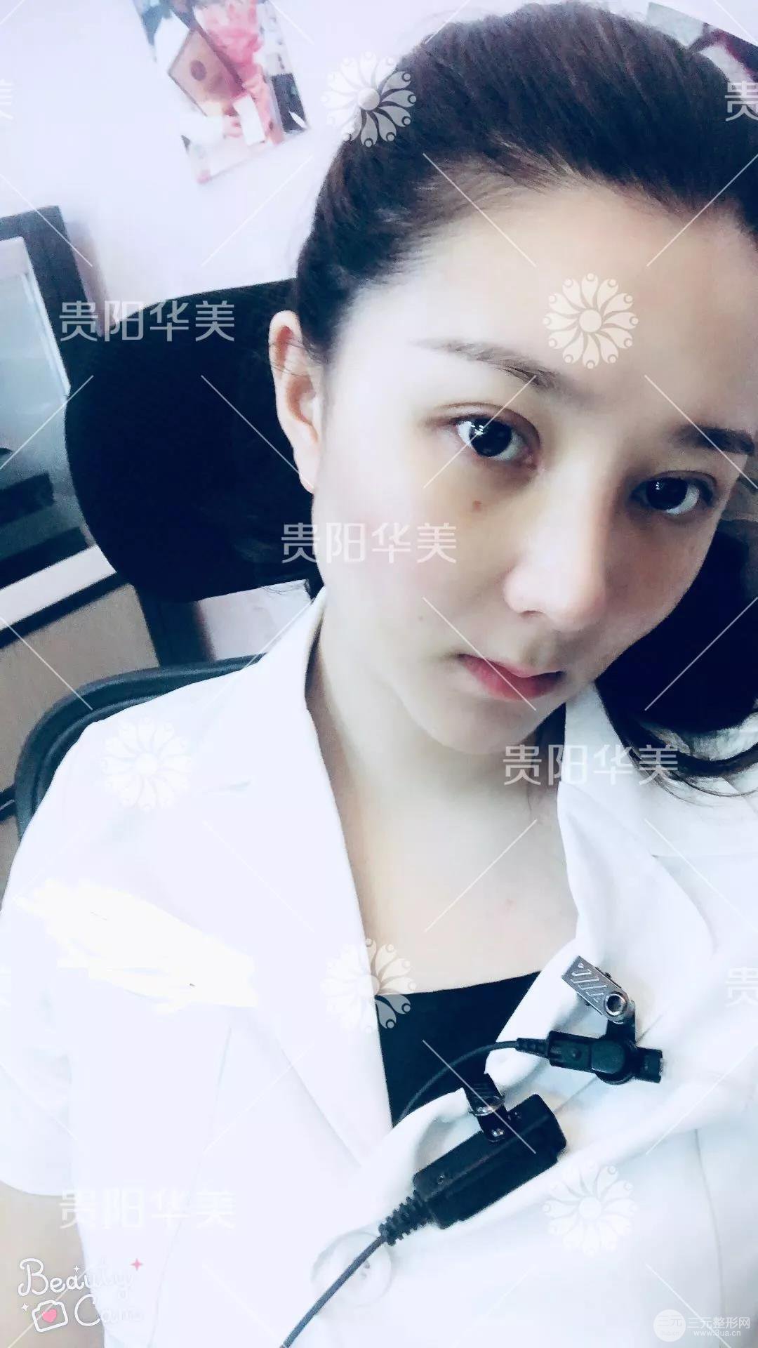 贵阳华美郭宗科全切双眼皮+假体隆鼻案例前后对比图 华美员工全脸整形实录