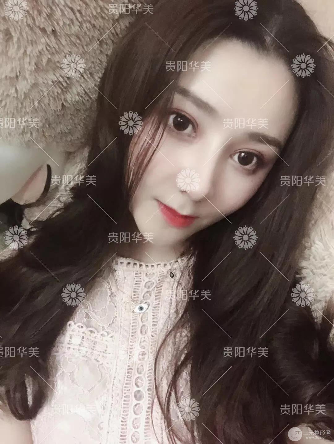 贵阳华美郭宗科全切双眼皮+假体隆鼻案例前后对比图 华美员工全脸整形实录