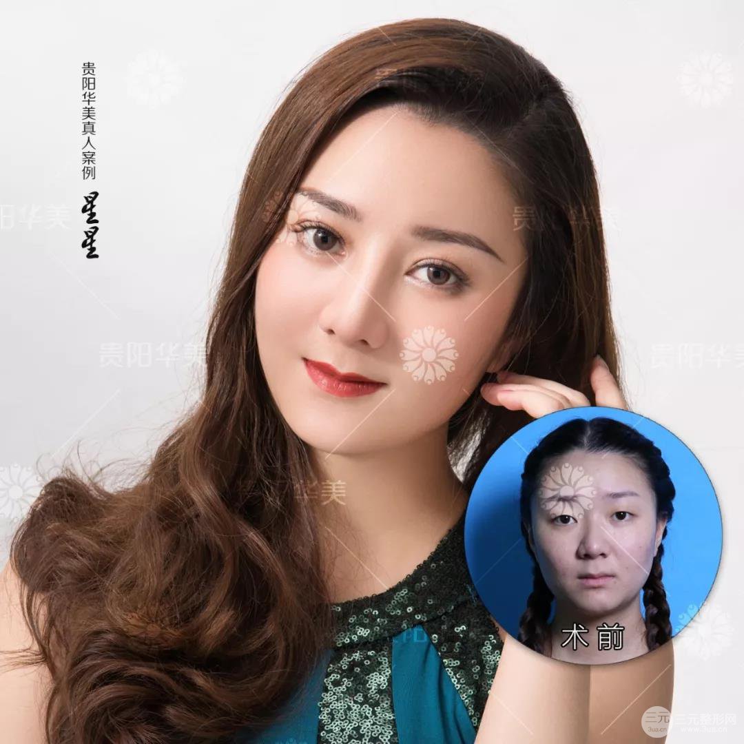 贵阳华美郭宗科全切双眼皮+假体隆鼻案例前后对比图 华美员工全脸整形实录