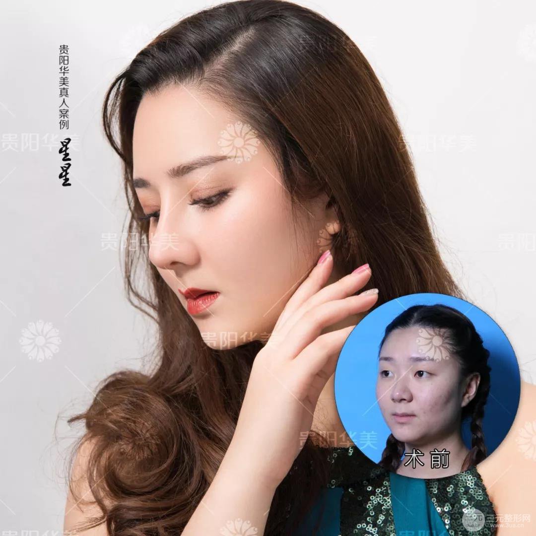 贵阳华美郭宗科全切双眼皮+假体隆鼻案例前后对比图 华美员工全脸整形实录