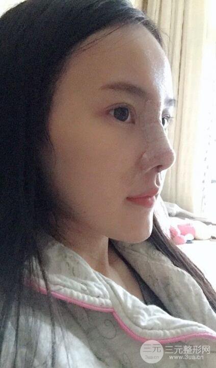 成都大华隆鼻怎么样?真实案例前后对比图记录恢复过程