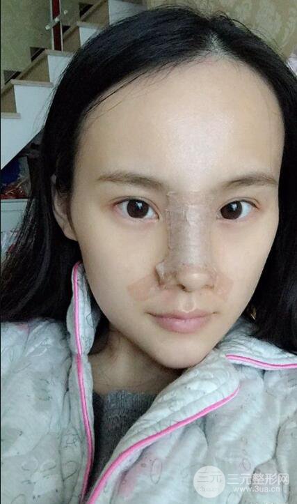 成都大华隆鼻怎么样?真实案例前后对比图记录恢复过程