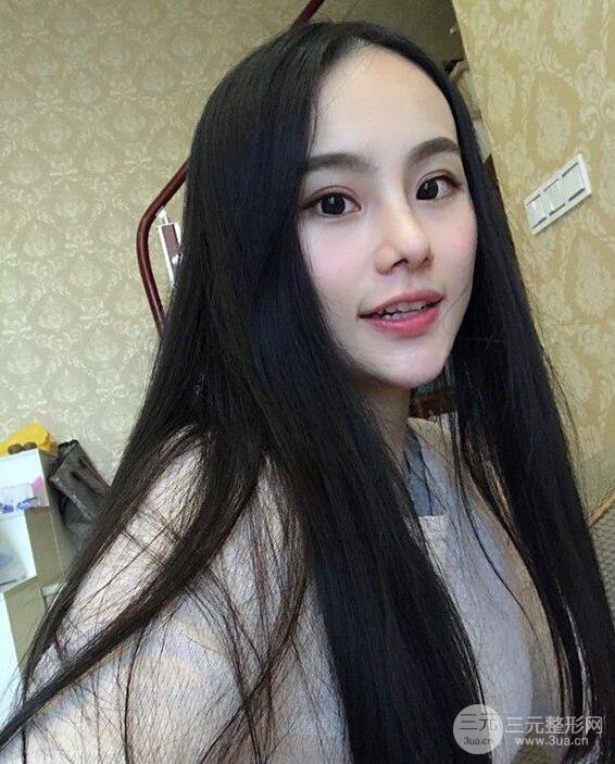 成都大华隆鼻怎么样?真实案例前后对比图记录恢复过程