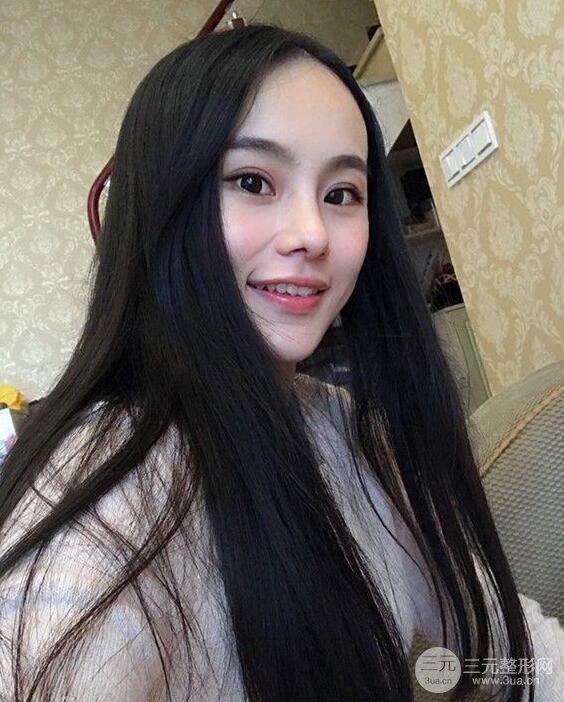 成都大华隆鼻怎么样?真实案例前后对比图记录恢复过程