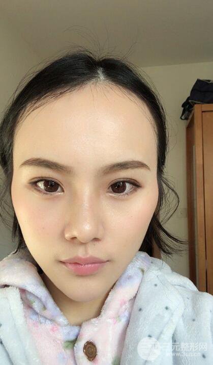 成都大华隆鼻怎么样?真实案例前后对比图记录恢复过程