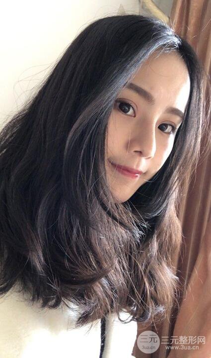 成都大华隆鼻怎么样?真实案例前后对比图记录恢复过程