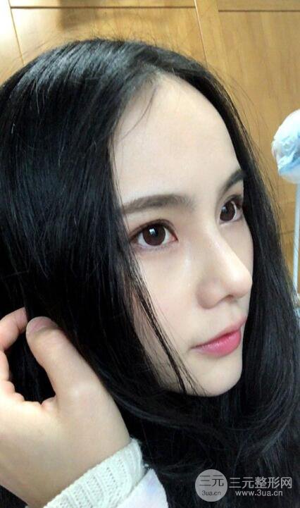 成都大华隆鼻怎么样?真实案例前后对比图记录恢复过程