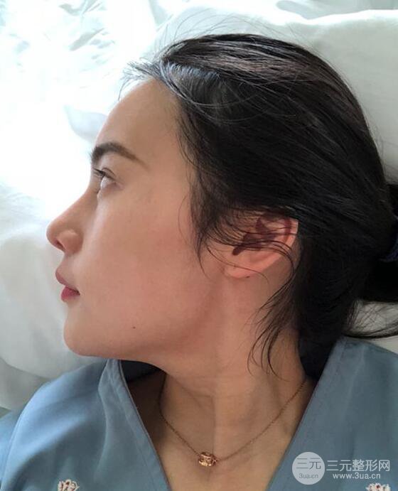 成都大华隆鼻怎么样?真实案例前后对比图记录恢复过程