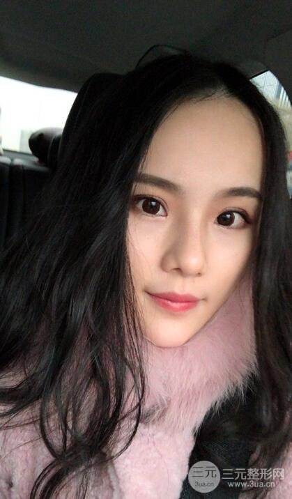 成都大华隆鼻怎么样?真实案例前后对比图记录恢复过程