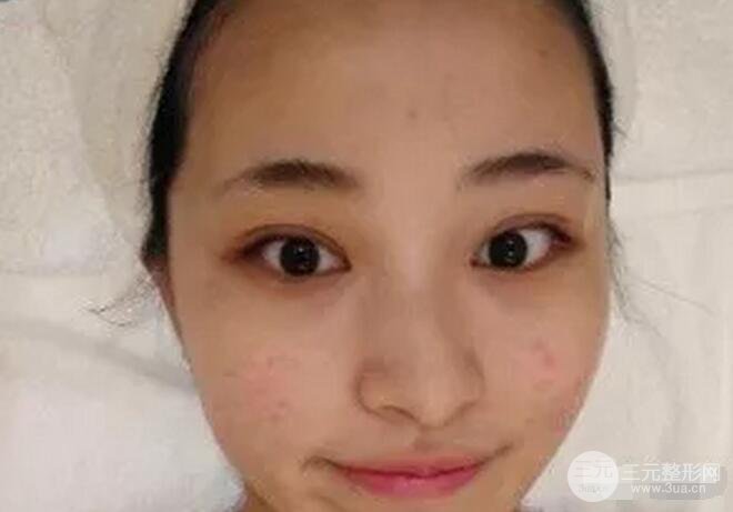 果酸换肤前后对比果图案例