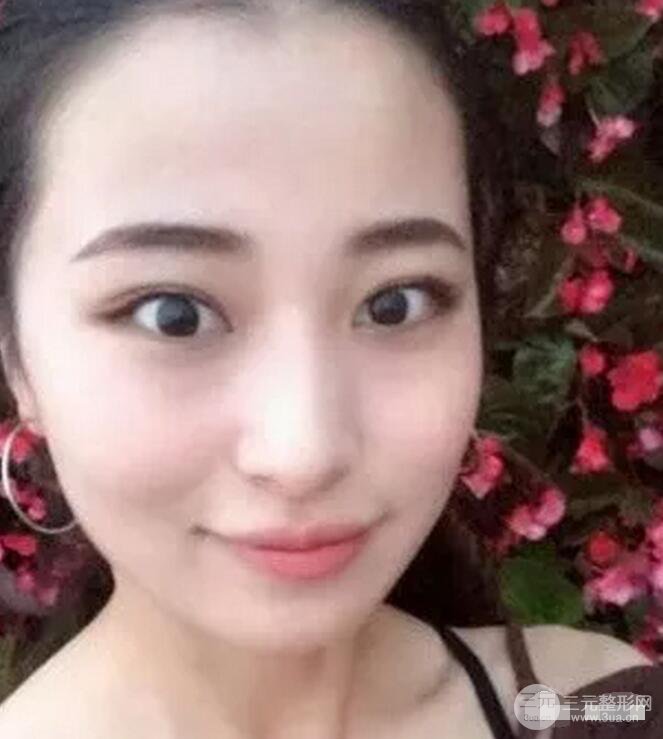 果酸换肤前后对比果图案例