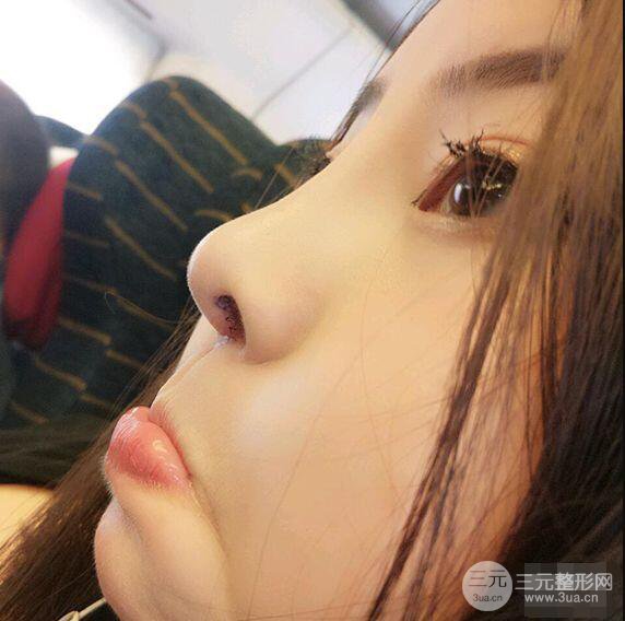 合肥壹加壹甘泉涌软骨隆鼻前后对比图|内附真人案例恢复前过程