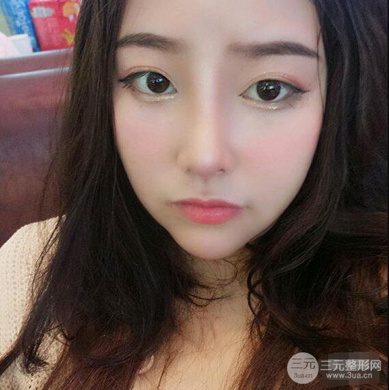 合肥壹加壹甘泉涌软骨隆鼻前后对比图|内附真人案例恢复前过程