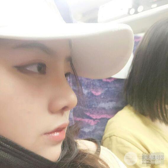 合肥壹加壹甘泉涌软骨隆鼻前后对比图|内附真人案例恢复前过程