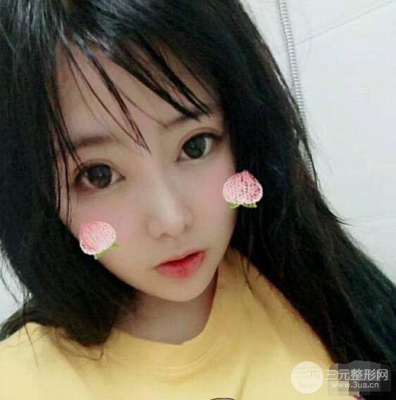 合肥壹加壹甘泉涌软骨隆鼻前后对比图|内附真人案例恢复前过程