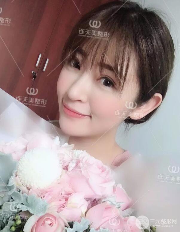 南京连天美整形周长兵隆鼻整形真人案例前后对比图|内附恢复过程心情日扎