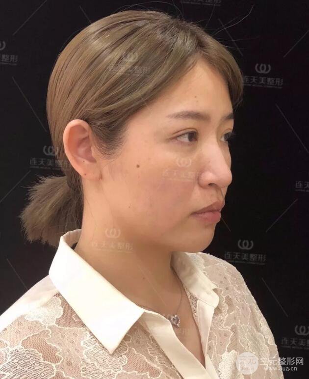 南京连天美整形周长兵隆鼻整形真人案例前后对比图|内附恢复过程心情日扎