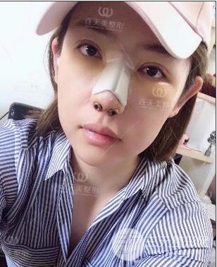 南京连天美整形周长兵隆鼻整形真人案例前后对比图|内附恢复过程心情日扎