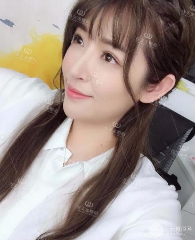 南京连天美整形周长兵隆鼻整形真人案例前后对比图|内附恢复过程心情日扎