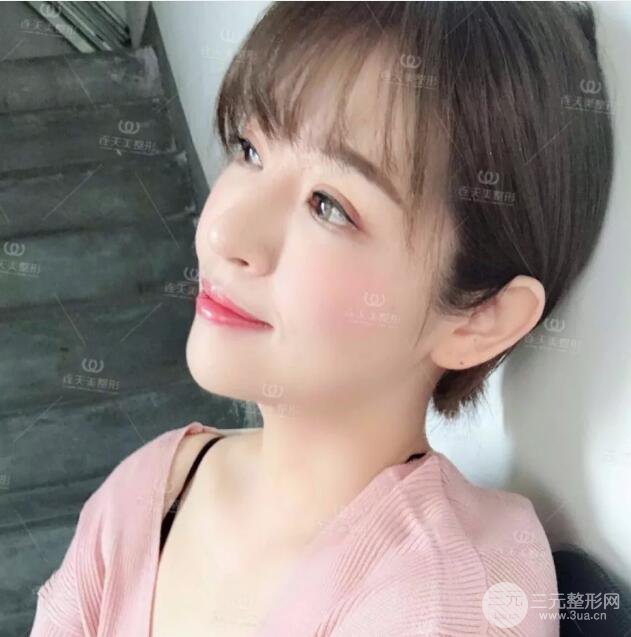 南京连天美整形周长兵隆鼻整形真人案例前后对比图|内附恢复过程心情日扎