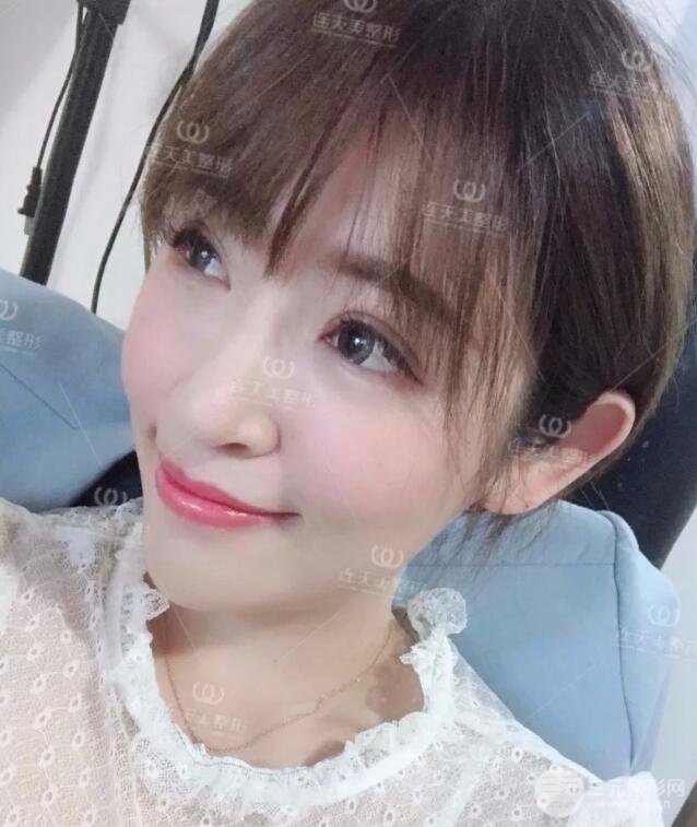 南京连天美整形周长兵隆鼻整形真人案例前后对比图|内附恢复过程心情日扎