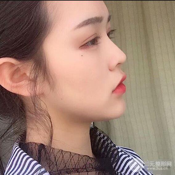 浙一医院美容科吴慧玲单眼皮割双眼皮前后对比图|单眼皮的秘密武器