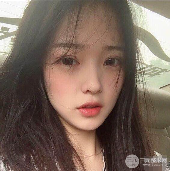 浙一医院美容科吴慧玲单眼皮割双眼皮前后对比图|单眼皮的秘密武器