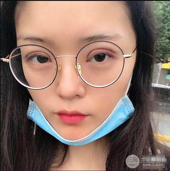 浙一医院美容科吴慧玲单眼皮割双眼皮前后对比图|单眼皮的秘密武器