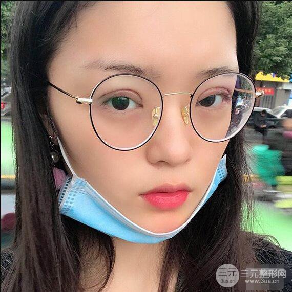 浙一医院美容科吴慧玲单眼皮割双眼皮前后对比图|单眼皮的秘密武器