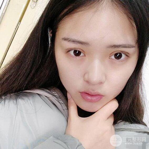 浙一医院美容科吴慧玲单眼皮割双眼皮前后对比图|单眼皮的秘密武器